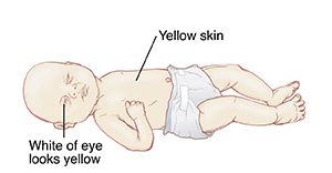 Baby with yellow skin and whites of eyes that look yellow because of jaundice.