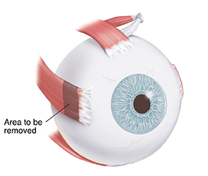 Three-quarter view of eye showing muscle on outside of eye. Shaded area shows part of muscle to be removed.