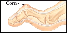 Image of rigid hammertoe