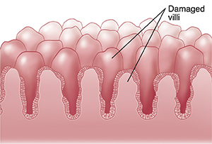 Closeup cross section of damaged intestinal villi.