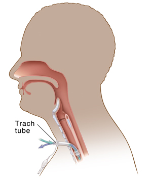 Cross section of head and airway showing cuffed tracheal and pilot tube.