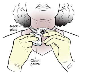 Woman cleaning skin around tracheostomy tube in neck.