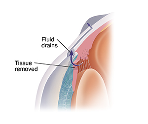 Cross section of eye showing trabeculectomy.