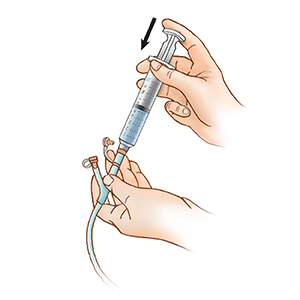 Close-up of hands holding plug-in syringe in feeding tube port, pressing plunger to flush water into feeding tube.