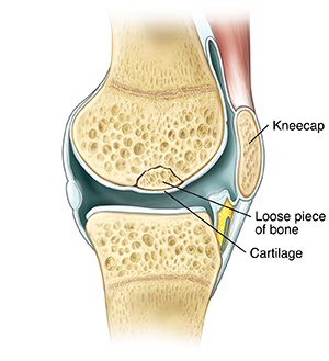 Side-view cross section of knee joint showing loose piece of bone broken off from leg bone and next to cartilage.