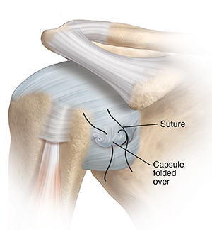 Front view of shoulder joint showing sutures placed to repair loose capsule.