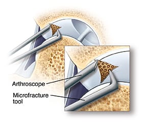 Hip joint with femoral head moved out of socket and arthroscope near damaged cartilage, showing microfracture tool creating small holes in bone.