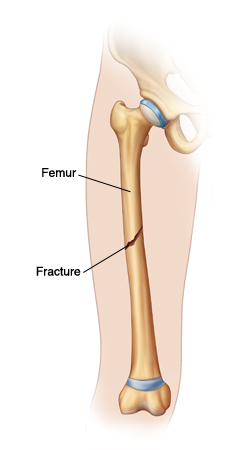 Outline of leg showing fracture in middle of femur.