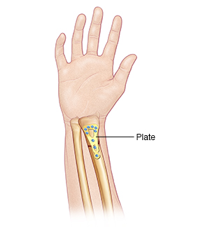 Back view of forearm showing external fixator holding fractured radius in place.