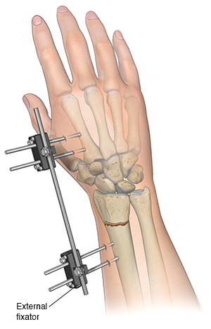 Front view of forearm with a plate holding fracture of the radius together.