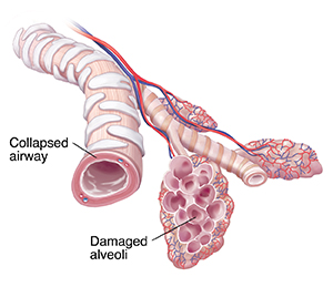 Bronchiole and alveolar sacs with emphysema.