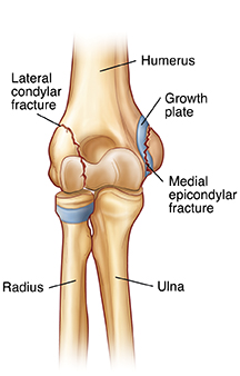 Front view of elbow joint showing lateral condylar fracture and medial epicondylar fracture.
