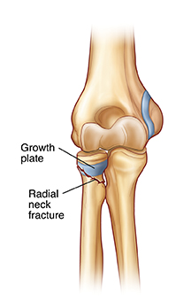 Front view of elbow joint showing radial neck fracture.