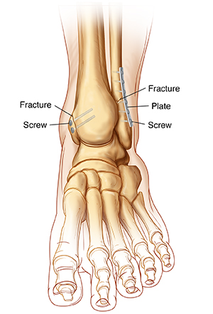 Front view of ankle and foot bones showing ankle fractures with internal fixation.