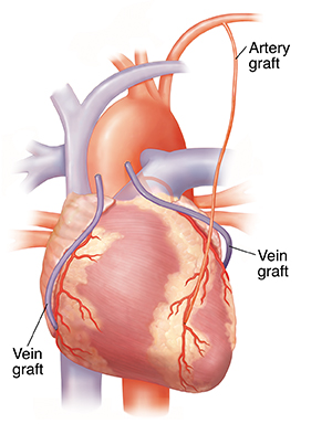 Front view of heart showing three bypass grafts on coronary arteries.