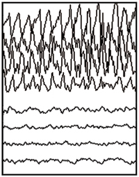 Registro de EEG con convulsiones parciales.