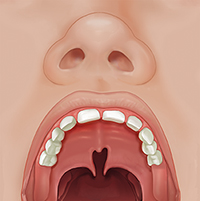 Vista frontal de la boca abierta de un niño donde se ve una hendidura parcial del paladar.