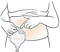 Primer plano de un abdomen donde se observan manos que retiran la bolsa de urostomía.