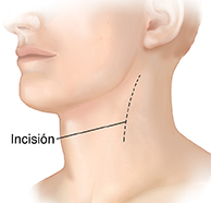 Vista de tres cuartos de una cabeza y un cuello donde puede verse la incisión en el cuello para una endarterectomía.