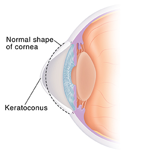 Corte transversal de un ojo con queratocono. La línea de puntos muestra la forma normal de la córnea.