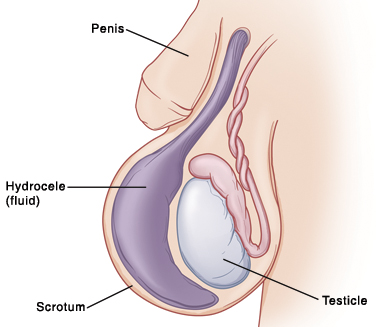 Primer plano del pene de un bebé en donde se ve un testículo dentro del escroto. Hay un saco grande de líquido (hidrocele) dentro del escroto que lo agranda.