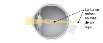 Corte transversal de un ojo que muestra la luz enfocándose en más de un lugar.