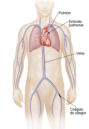 Vista frontal de la figura de un hombre con una flecha que muestra la trayectoria de un coágulo de sangre de la vena de la pierna al pulmón, causando embolia pulmonar.