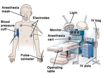 Contorno de un niño con mascarilla de anestesia sobre la cara, manguito para medir la presión arterial en la parte superior del brazo, manguito dl oxímetro de pulso en el dedo y electrodos sobre el pecho. En el fondo se ve la mesa de operaciones, el soporte IV (vía intravenosa), la bolsa IV, el carro de anestesia, el monitor y la luz del quirófano.