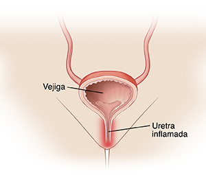 Vista frontal de la pelvis de una mujer. Se ve un corte transversal de la vejiga en la parte inferior de la pelvis con la uretra que sale de la vejiga hacia el exterior. La uretra está inflamada (hinchada).