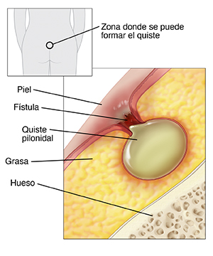 Contorno de una figura humana vista de espaldas donde se observan las nalgas con un círculo pequeño encima del pliegue interglúteo que indica dónde puede formarse un quiste. Primer plano de un corte transversal de piel, grasa y hueso. Quiste pilonidal en la capa de grasa conectado a la piel por medio de una fístula. La piel alrededor de la fístula está inflamada.