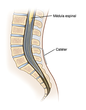 Corte transversal visto de lado de la parte inferior de la columna, donde se observa el catéter insertado en el conducto vertebral.