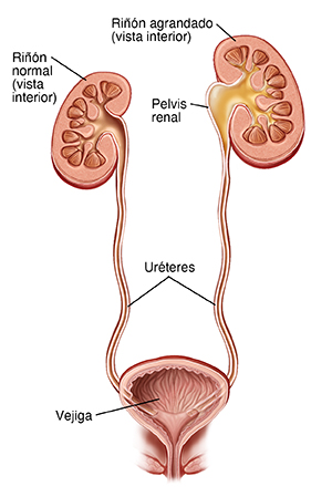 Vista delantera de un corte transversal de los riñones, los uréteres y la vejiga. El uréter izquierdo está cerrado y la orina regresa al riñón.