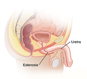 Corte transversal visto de lado de un cuerpo masculino en el que se observan los intestinos, el recto, la vejiga, la próstata, el pene, los testículos y la uretra con estenosis.
