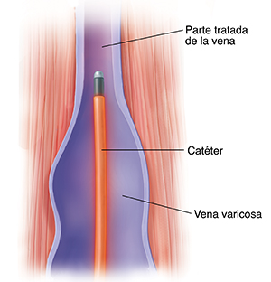 Corte transversal de músculo y vena donde puede verse un catéter de ablación en la vena.