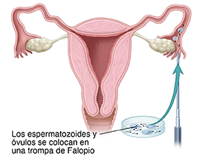 Vista frontal de un corte transversal de un aparato reproductor femenino con un instrumento inyectando esperma y óvulos en la trompa de Falopio.