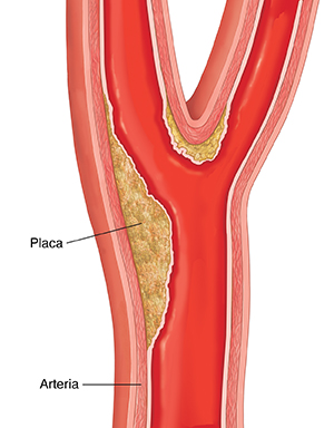 Corte transversal de una arteria carótida con acumulación de placa.