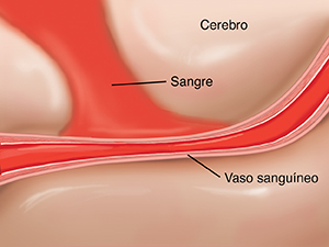Corte transversal de una arteria en el cerebro donde se ve una hemorragia que provoca un vasoespasmo.