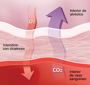 Primer plano del tejido intersticial del pulmón donde se observa el intercambio de gases deficiente entre los alvéolos y los capilares a causa de la enfermedad pulmonar intersticial.