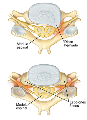 Vista superior de la vértebra cervical donde se observa la hernia de disco. Vista superior de la vértebra cervical donde se observan los espolones óseos.