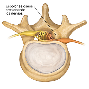 Vista superior de las vértebras lumbares y del disco donde se observa un espolón óseo presionando un nervio raquídeo.