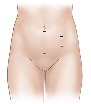Vista frontal del abdomen de una mujer donde se observan posibles sitios de inserción para cirugía pélvica laparoscópica.