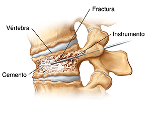 Vista lateral de una vértebra con fractura por compresión. Una aguja inyecta cemento en la fractura.