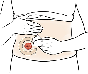 Abdomen de una mujer donde pueden verse manos que aplican una barrera cutánea alrededor del estoma. 
