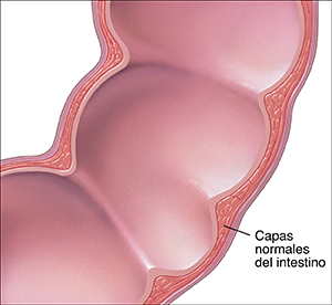 Corte transversal del colon en donde se muestran las capas normales de la pared intestinal.
