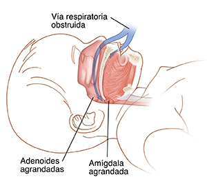 Contorno de la cabeza de un niño que muestra adenoides agrandadas y amígdalas agrandadas. La flecha muestra que las adenoides y las amígdalas agrandadas bloquean el flujo de aire.