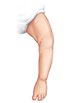 Contorno de la pierna del bebé que muestra un pie normal.
