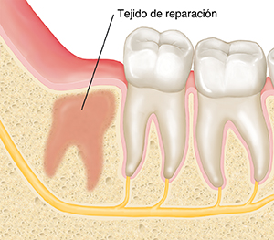 Primer plano de corte transversal de maxilar y molares en donde se ve tejido cicatrizado en el sitio del que se extrajo una muela de juicio.