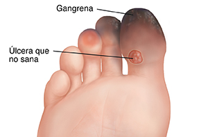 La planta del pie presenta una úlcera que no cicatriza en el dedo gordo y gangrena en los tres primeros dedos.