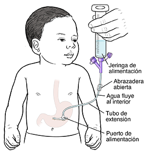 Contorno de un bebé con sonda insertada en el estómago. El puerto de alimentación se encuentra cerca de la piel y la abrazadera está abierta en el tubo de prolongación. Se inserta la jeringa de alimentación en el tubo de prolongación. El agua fluye dentro del estómago del bebé.