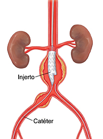 Vista frontal de la aorta abdominal con un aneurisma en la que se ve un catéter guiando la colocación del injerto.